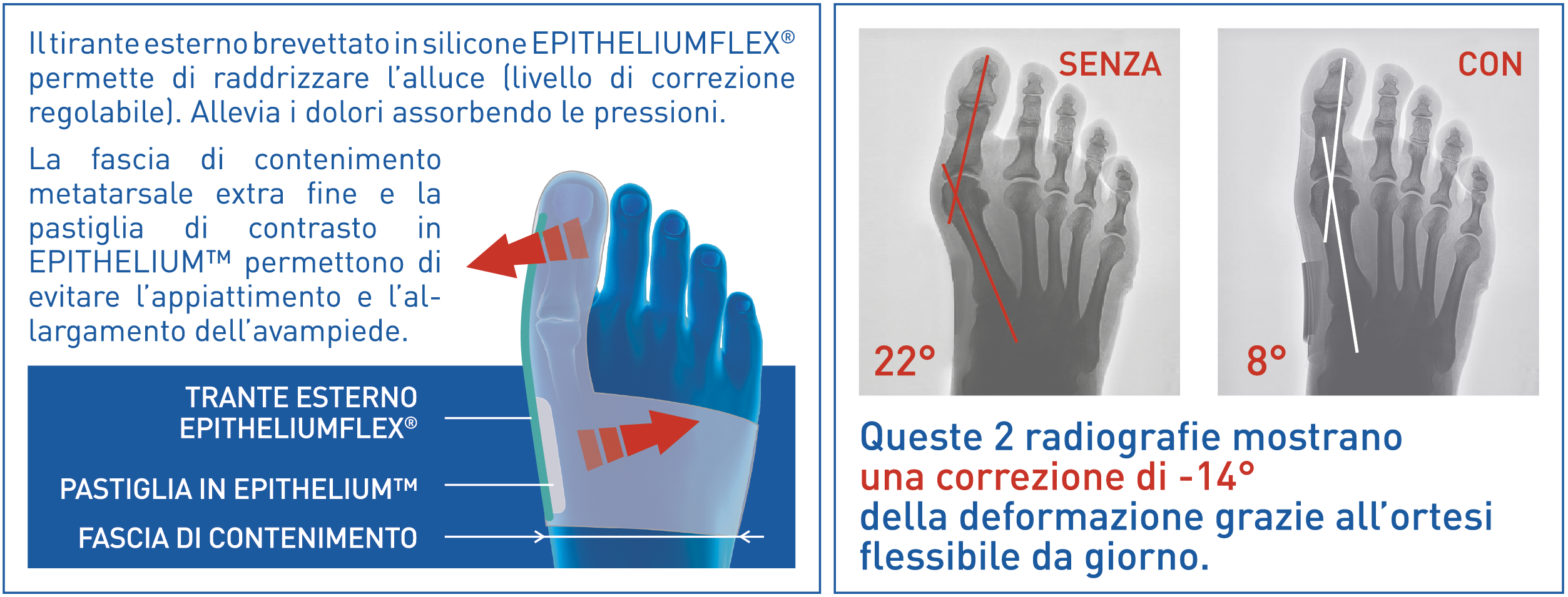 schema orthese hallux valgus